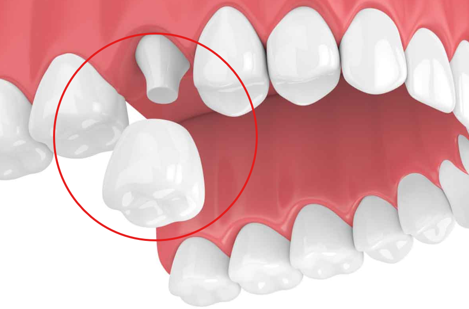 single Posterior Crown