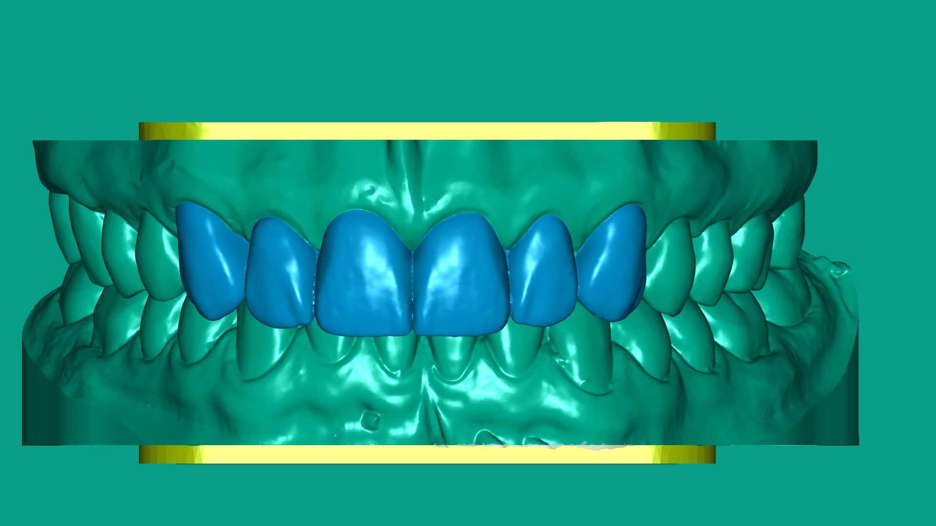 Restorative Wax-up